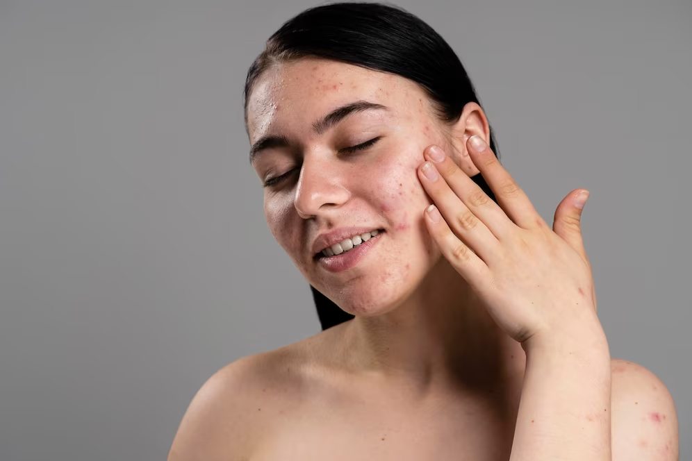 Best 4 Acne Scar Removal Products in India