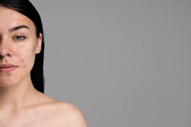 Best 4 Anti Acne Scar Products For Women In India