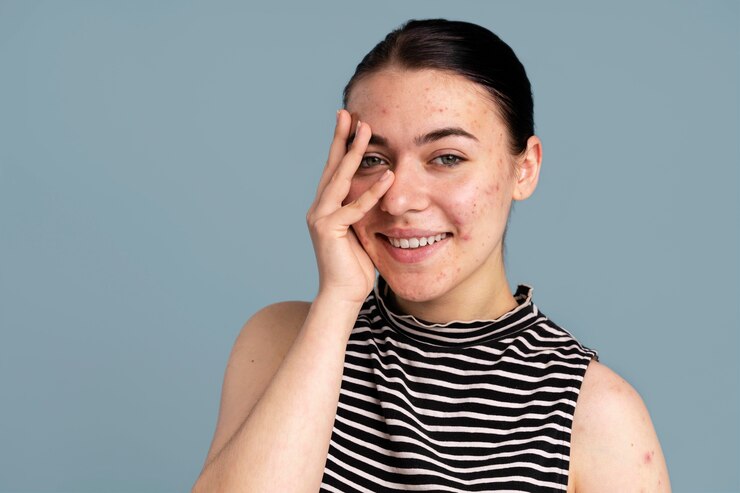 How Acne Scars Can Be Removed?